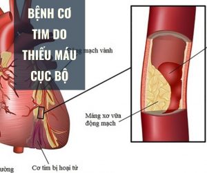 benh co tim do thieu mau cuc bo