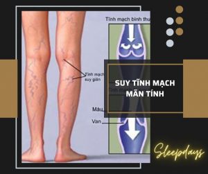 benh suy tinh mach man tinh