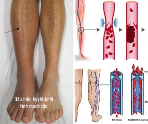 dau hieu huyet khoi tinh mach sau
