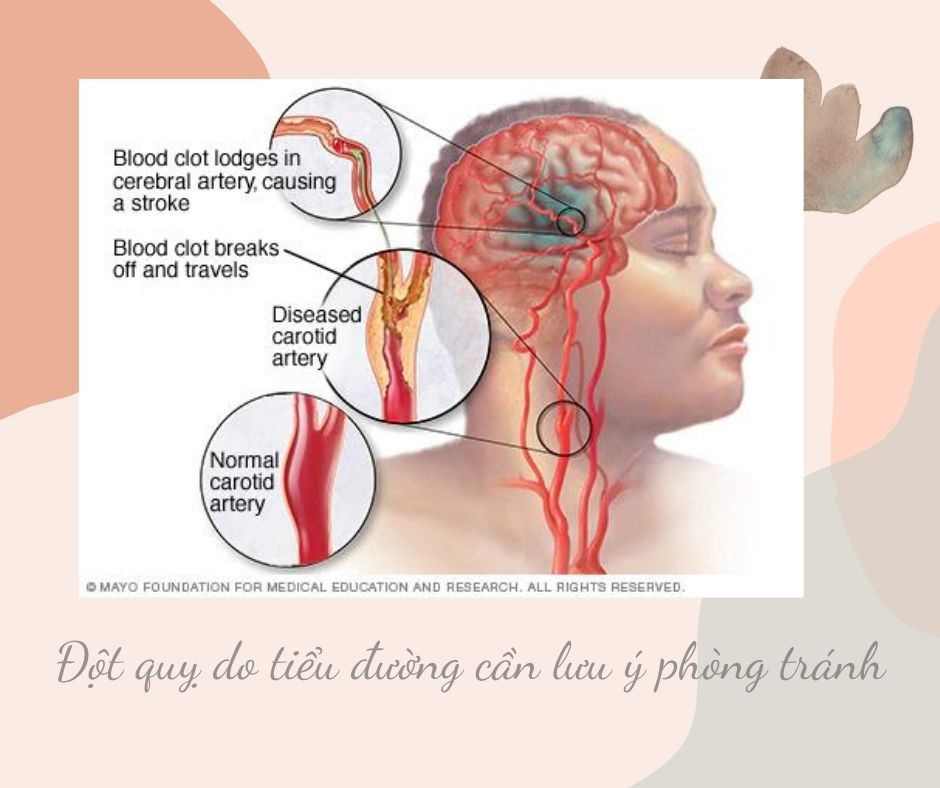 Đột quỵ do tiểu đường: triệu chứng và điều trị 7 dot quy do tieu duong