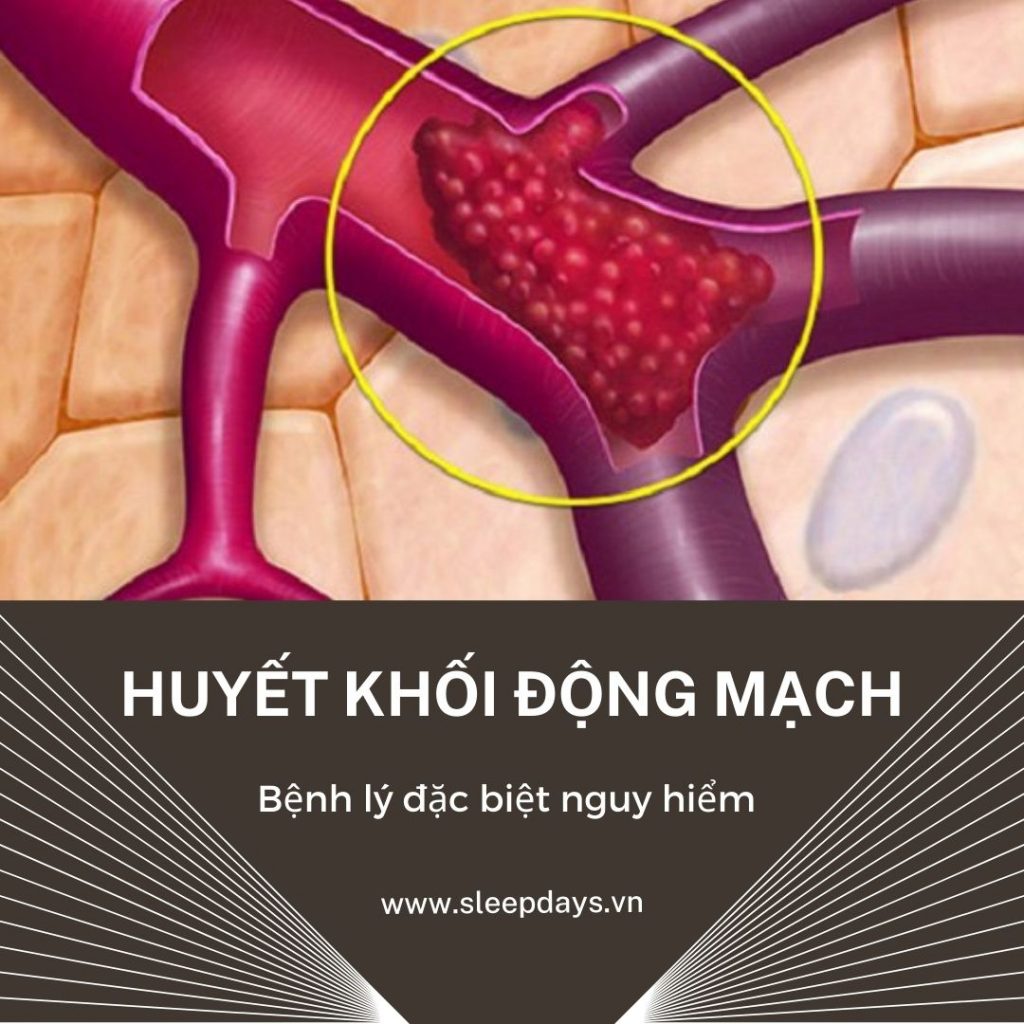 huyet khoi dong mach