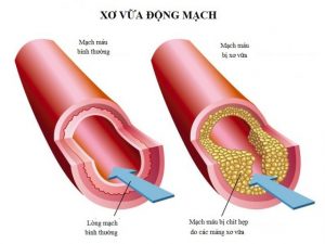 phong xo vua dong mach