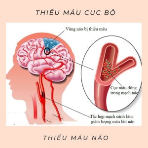 thieu mau cuc bo