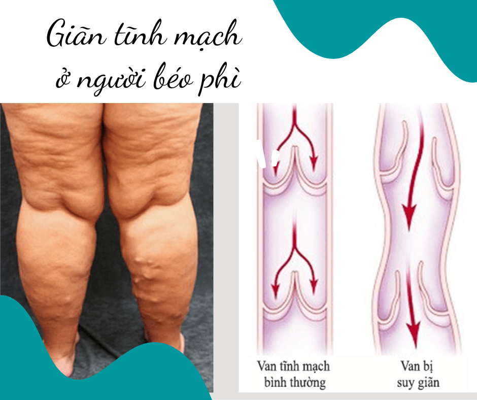 gian tinh mach o nguoi beo phi