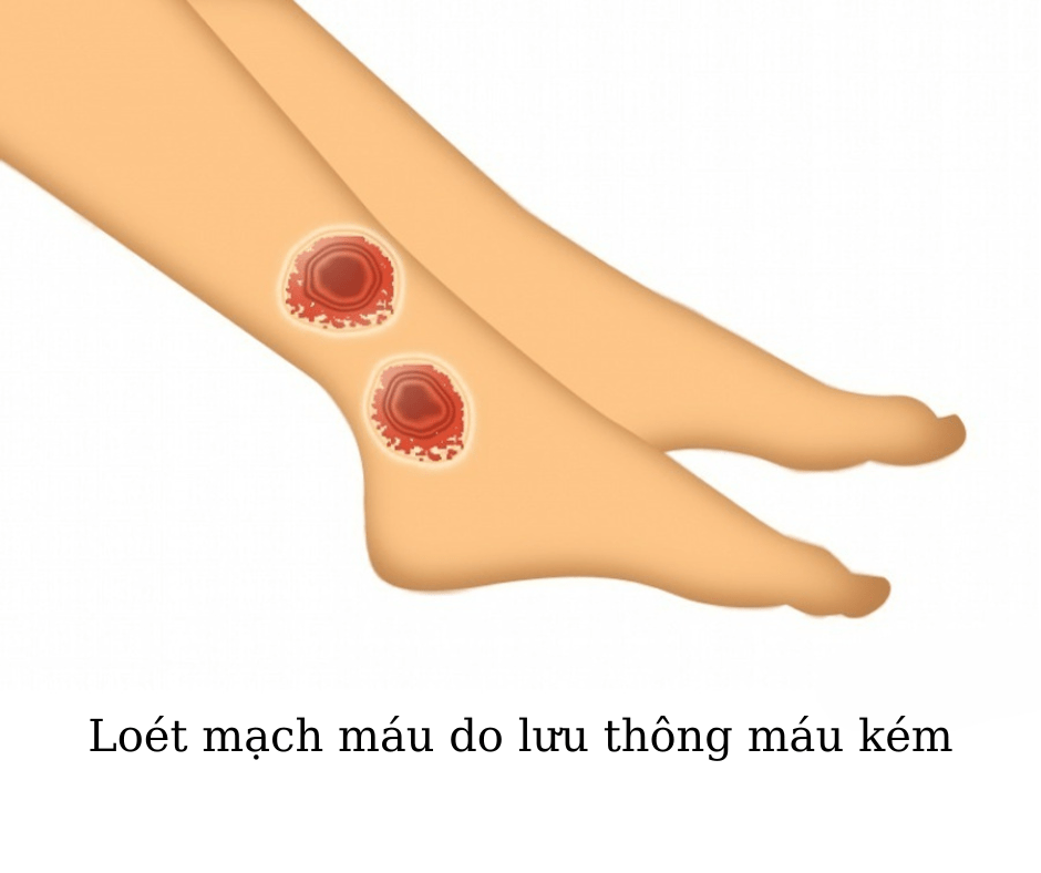 loet mach mau do luu thong mau kem