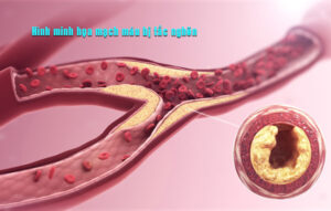 cac dau hieu tac nghen mach mau