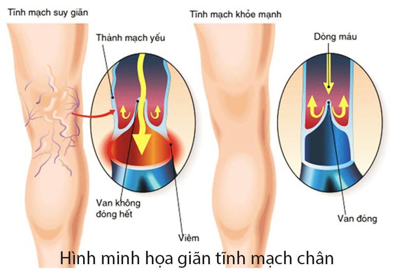 gian tinh mach chan