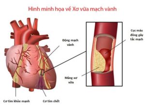 hinh minh hoa xo vua mach vanh