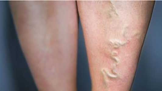 Mua thuốc trị giãn tĩnh mạch ở đâu? 3 thuoc dieu tri gian tinh mach