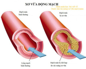 xo vua mach mau 2023