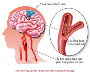 bieu hien thieu mau nao thuong gap