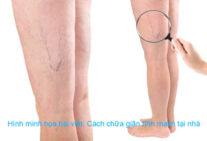 cach chua gian tinh mach tai nha
