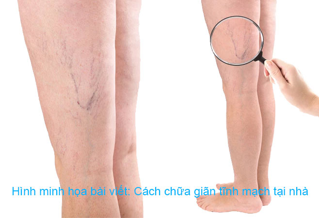 Cách chữa giãn tĩnh mạch tại nhà 2 cach chua gian tinh mach tai nha