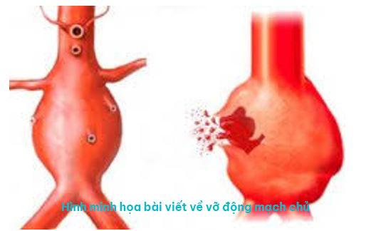 Vỡ động mạch chủ - Sleepdays 3 vo dong mach chu
