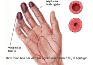 tac mach mau o tay la benh gi