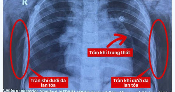 Chơi xe điện 3 bánh, bé 6 tuổi ngã vỡ khí quản, nguy kịch tính mạng 1 tai nan 17037308142131802989674 202 0 608 650 crop 17037308458891601353397