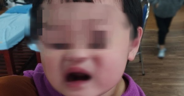 Bé 2 tuổi bị liệt mặt, méo miệng sau khi đi được bố mẹ cho đi xe máy buổi tối, bác sĩ chỉ cách bảo vệ trẻ trong mùa lạnh 1 liet mat 17066625835622126354833 127 0 501 599 crop 17066632326272126173749