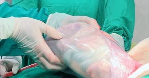 Bé sinh đôi ở Hưng Yên chào đời nằm nguyên trong 'bọc điều' hiếm gặp 1 bocdieu2 1716607696443 1716607696558357058154 89 121 400 618 crop 17166087082841190580171