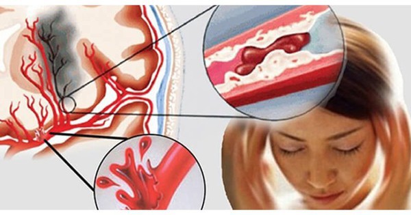 Vì sao đột quỵ gia tăng ở người trẻ? 1 avatar1717754827289 17177548276662001615915