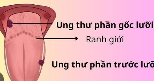 Người bệnh ung thư lưỡi nên tập luyện như thế nào? 1 avatar1717755388190 17177553884701864786378