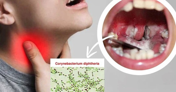 Ai có nguy cơ cao mắc bệnh bạch hầu? 5 nhóm người này cần cảnh giác 1 benh bach hau 1723522890161557609472 0 0 397 635 crop 1723523095742476520362