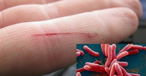 benh vi khuan an thit nguoi whitmore 17275749369991406963177 0 66 346 620 crop 17275750450871775264488