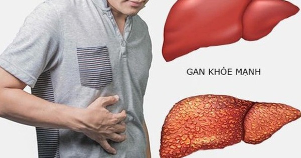 Gầy sút 5 kg trong 1 tháng, người đàn ông đi khám bất ngờ phát hiện ung thư gan 1 ung thu gan1 17288240224621221856662 0 0 413 661 crop 17288240385761136024606