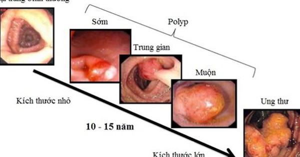 ung thu truc trang 17304742160141810582213 0 30 337 569 crop 1730474242439788757879