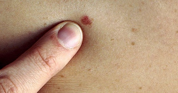 dau hieu cua benh ung thu da 1721024010027 172102401051347689614 1735101434525 1735101434864823855296 0 0 375 600 crop 17351015270371864142952