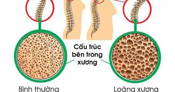 Mối nguy hiểm tiềm ẩn khi phụ nữ thiếu canxi 1 avatar1735656441996 17356564422721461381764