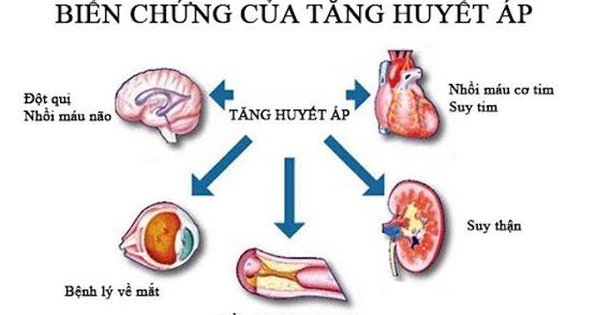 Người phụ nữ 35 tuổi ở Hà Nội bị suy thận, cao huyết áp thừa nhận một sai lầm nhiều người Việt mắc phải 1 tang huyet ap 1736589900184290906486 0 0 425 680 crop 1736589931165359198375