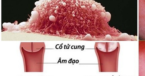 Người phụ nữ 31 tuổi ở Quảng Ninh phát hiện ung thư cổ tử cung từ dấu hiệu nhiều người Việt mắc phải 1 ung thu o tu cung 1737507058460585738595 64 0 335 433 crop 1737507299654622893476