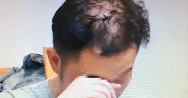 Nam sinh 16 tuổi đã hói nửa đầu vì 1 thói quen khi ngủ người càng trẻ tuổi càng dễ “sa vào bẫy” 1 avatar1748734232473 1748734232747666754553