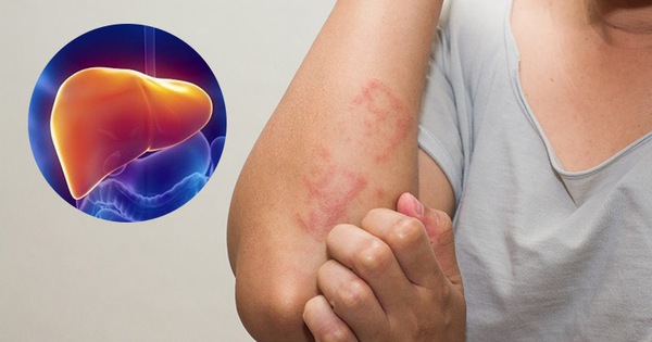 Mùa hè nắng nóng, khi nào nên thải độc gan, đây là 3 nhóm người cần cảnh giác 1 nong gan 1746004846836563027318 1 0 481 768 crop 17460048684031525341316