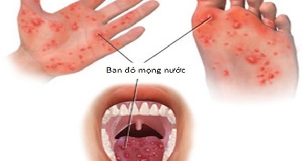 Bệnh tay chân miệng đang gia tăng, bố mẹ cần biết điều này để bảo vệ con 1 untitled chan tay mieng 1 155425 190319 66 1649822080728998192156 1747916396800 17479163982631103004387 40 0 440 640 crop 1747916490099825595556