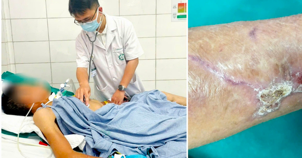 Người đàn ông 65 tuổi co giật, cứng hàm sau cú ngã đập tay vào thanh gỗ 1 21e9d80d 1b04 426b a632 c4140e88ebd7mceclip0 1750071582859 17500715835801318119029 0 0 528 845 crop 1750071670993612638492