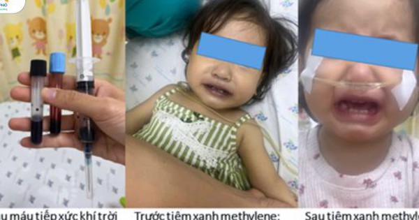 Bé 16 tháng tuổi nguy kịch sau bữa ăn trưa do mẹ nấu, bác sĩ chỉ rõ nguyên nhân 1 cap cuu 17503170719311232463809 0 56 322 571 crop 17503171857651471669989