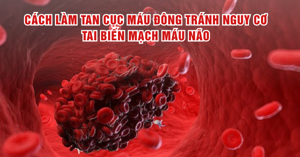 Cách hỗ trợ làm tan cục máu đông tránh nguy cơ tai biến mạch máu não 2 ntp gdnet hue t7 17515178978421142675990 0 0 375 600 crop 17515179013081331910441