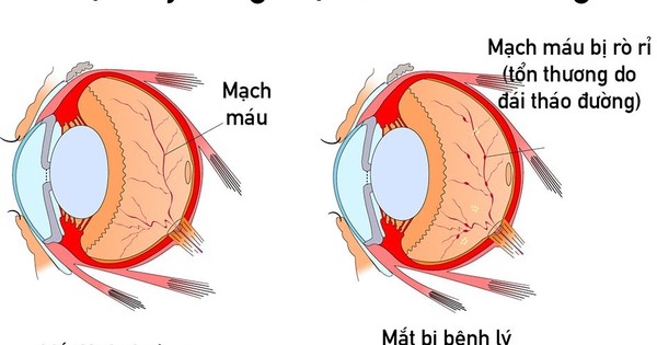 benh ly vong mac dai thao duong 0 1755856004167 1755856004875118524372 6 0 600 950 crop 1755856089757298952373