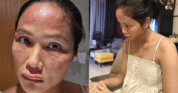 Hoa hậu H'Hen Niê bất ngờ chia sẻ mặt sưng nề, mẩn đỏ sau sinh con, căn bệnh cô mắc nguy hiểm thế nào? 1 hhen nie bi me day 1761237783867629185358 82 0 751 1070 crop 17612379420051167040444