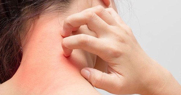 Mẹ bỉm cần cẩn trọng với mề đay sau sinh: Đừng chủ quan với những vết nổi ngứa 1 me day cholinergic la gi bieu hien the nao nguy hiem khong 17615337949841930724067 0 0 459 735 crop 17615337986672003303889