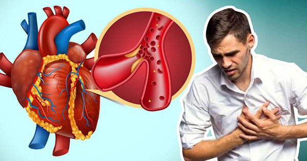 Người đàn ông 52 tuổi ở Quảng Ninh đột ngột lên cơn nhồi máu cơ tim trong tình huống nguy cấp, bác sĩ cân não xử trí 1 nhoi mau co tim 1 17612356846271976160138 0 35 432 726 crop 17612357016051797167140
