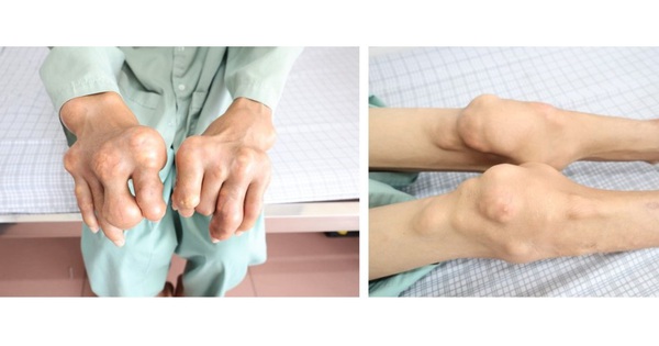 thumb bien chung benh gout 17600042453501763738758 17600042640191674170542 0 0 594 950 crop 17600042671931951439488