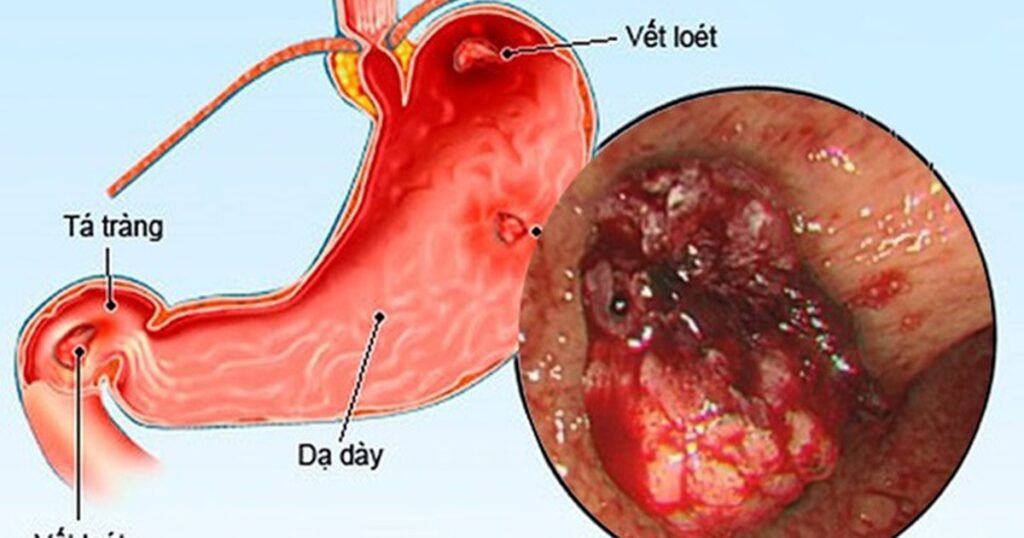 Áp lực mùa thi, nam sinh 15 tuổi hai lần nhập viện vì loét dạ dày 1 viem loet da day 17673224427582005748438 19 0 519 800 crop 1767322473626687289115
