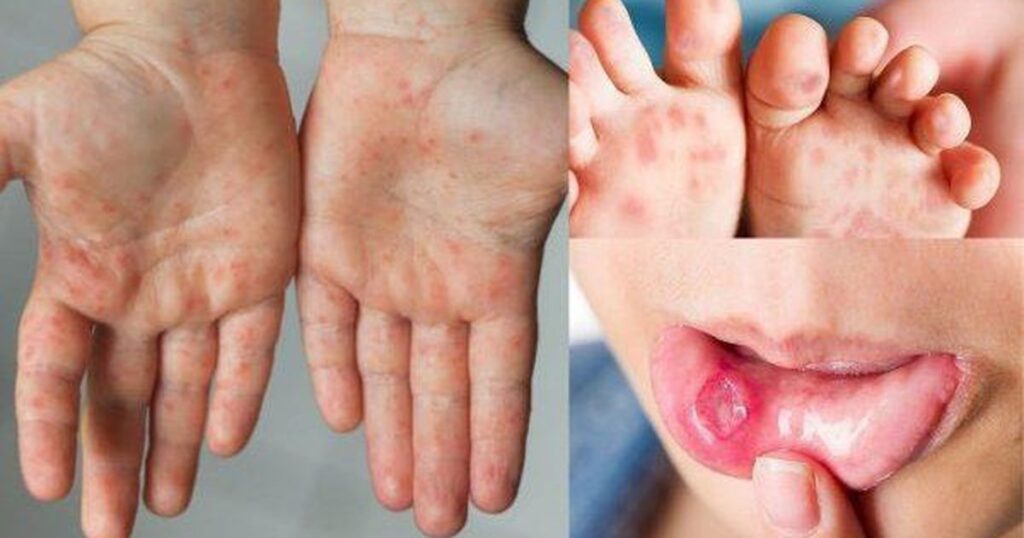 benh tay chan mieng dieu tri the nao 17744994653271805371788 23 0 398 600 crop 177449949346334747610