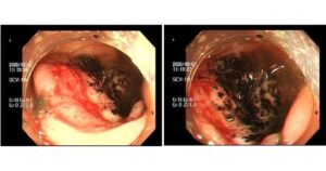 thumb ung thu dai truc trang 17740728413621766362422 17740732597301085226249