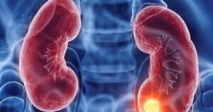 ung thu than 5 17746001057911768628013 0 25 366 611 crop 1774600124746529177748