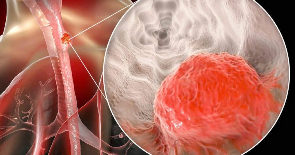 ung thu thuc quan 5 177459771999457298929 93 0 733 1024 crop 1774597740730113958840