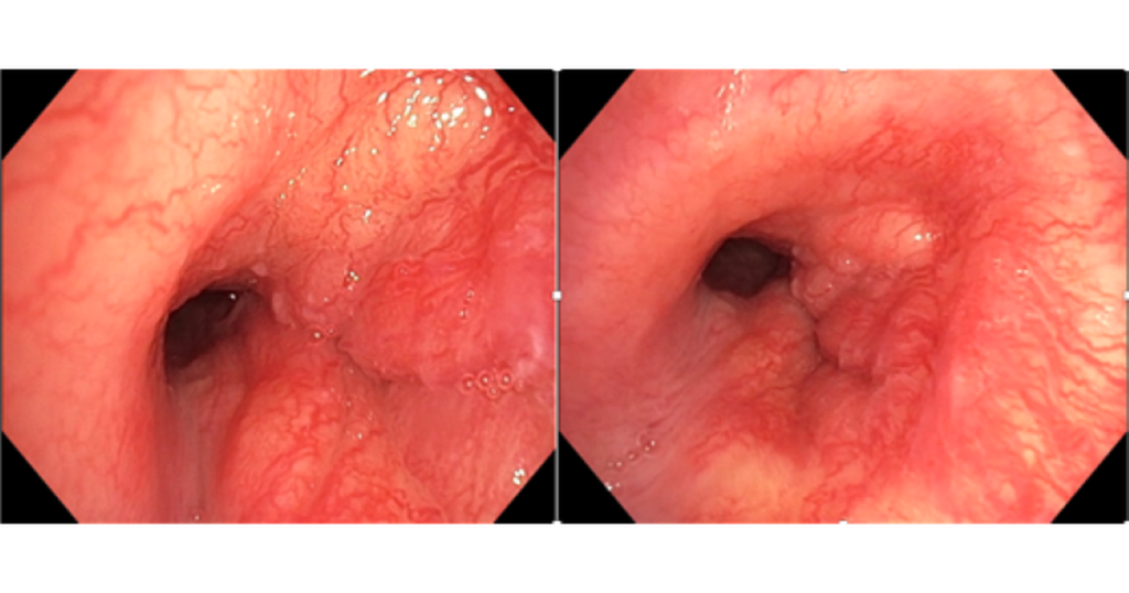 thumb ung thu duong tho 17769122649131073491298 17769125062351780109431